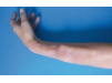 Prothèse Fracture Avant Bras ou Tibia ou Clavicule