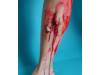 Fracture Ouverte du Tibia